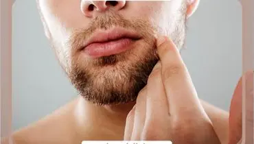 کاشت ریش ؛ راه‌حلی دائمی برای ریش‌های کم‌پشت و ناهماهنگ، جذاب‌تر از همیشه!