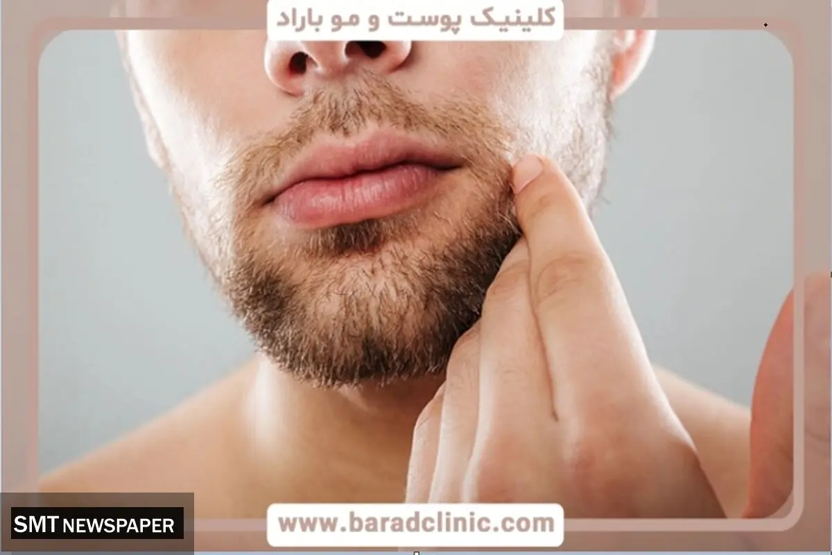 کاشت ریش ؛ راه‌حلی دائمی برای ریش‌های کم‌پشت و ناهماهنگ، جذاب‌تر از همیشه!