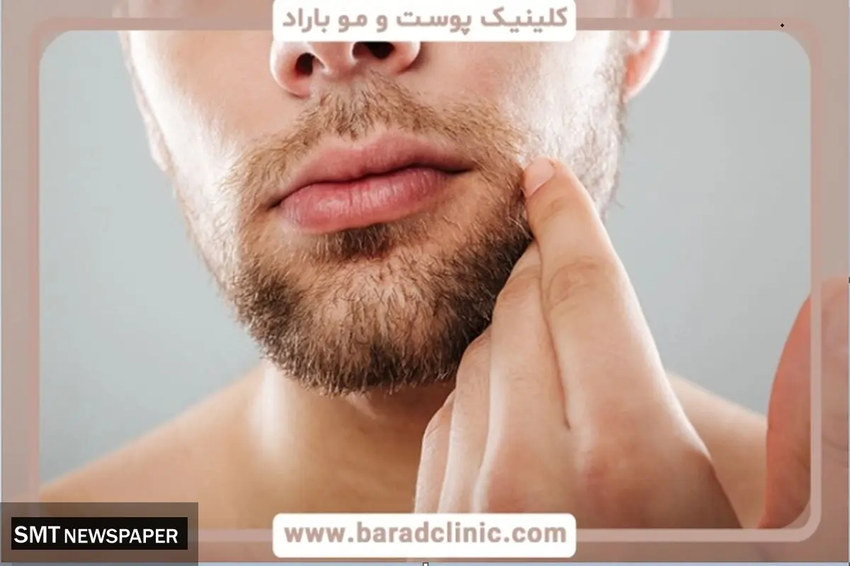 کاشت ریش ؛ راه‌حلی دائمی برای ریش‌های کم‌پشت و ناهماهنگ، جذاب‌تر از همیشه!