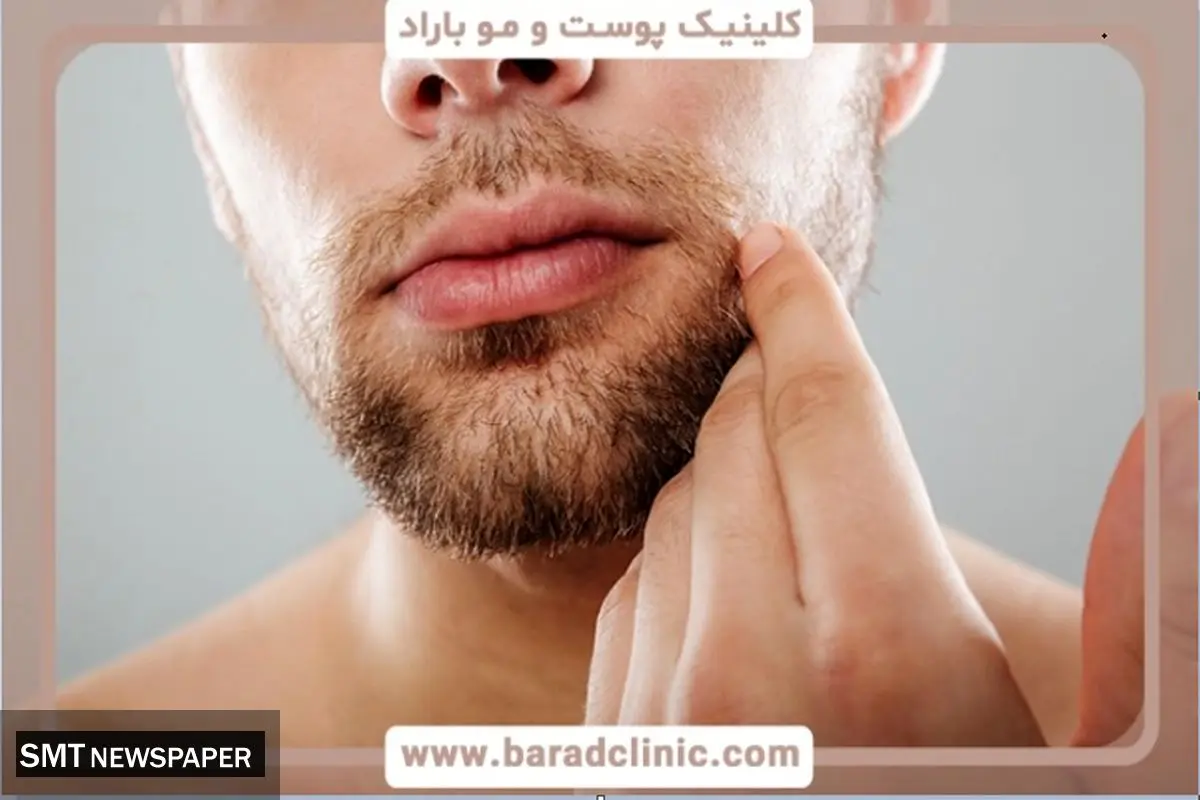 کاشت ریش ؛ راهحلی دائمی برای ریشهای کمپشت و ناهماهنگ، جذابتر از همیشه!