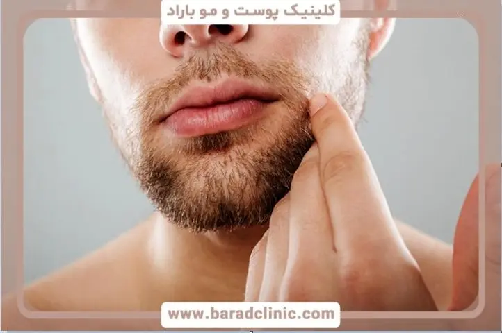 کاشت ریش ؛ راهحلی دائمی برای ریشهای کمپشت و ناهماهنگ، جذابتر از همیشه!