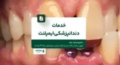 خدمات دندانپزشکی ایمپلنت