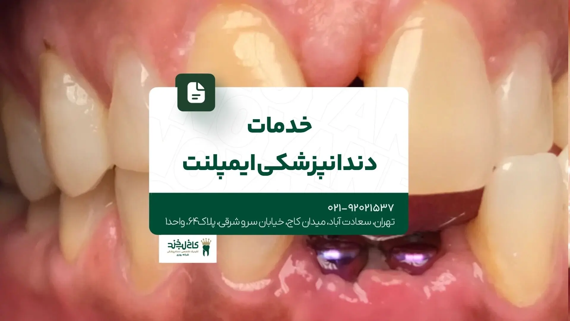 خدمات دندانپزشکی ایمپلنت