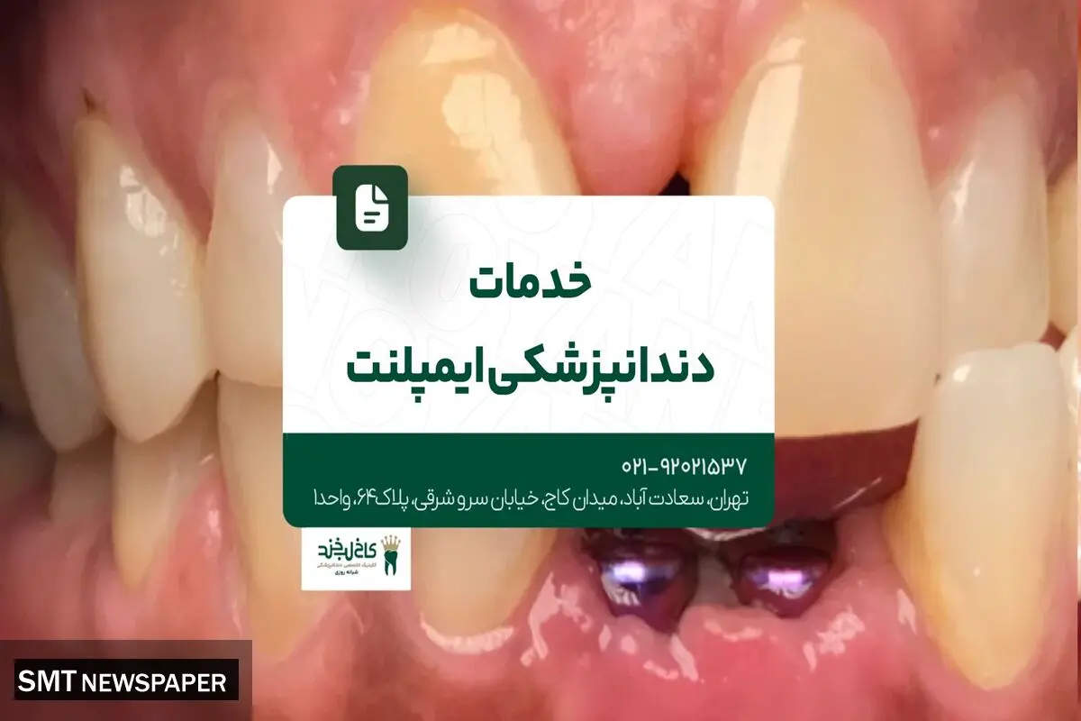 خدمات دندانپزشکی ایمپلنت