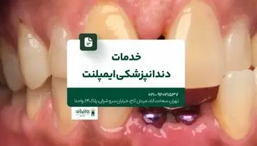 خدمات دندانپزشکی ایمپلنت