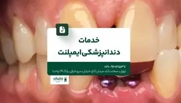 خدمات دندانپزشکی ایمپلنت