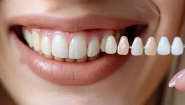 لمینت دندان چیست؟ + معرفی بهترین دکتر لمینت دندان در تهران