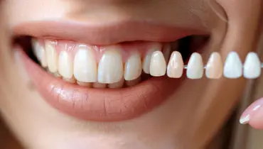 لمینت دندان چیست؟ + معرفی بهترین دکتر لمینت دندان در تهران