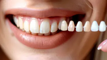 لمینت دندان چیست؟ + معرفی بهترین دکتر لمینت دندان در تهران