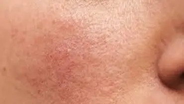 کمبود این ویتامین باعث چین و چروک صورت و خستگی می شود