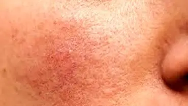 کمبود این ویتامین باعث چین و چروک صورت و خستگی می شود