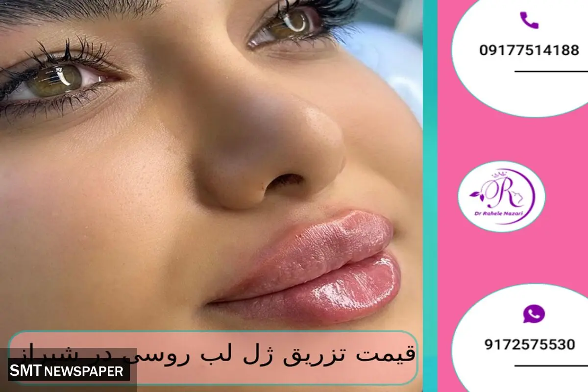 قیمت تزریق ژل لب روسی در شیراز