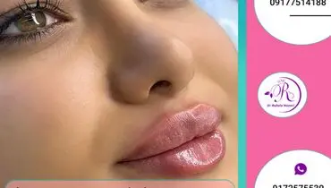 قیمت تزریق ژل لب روسی در شیراز