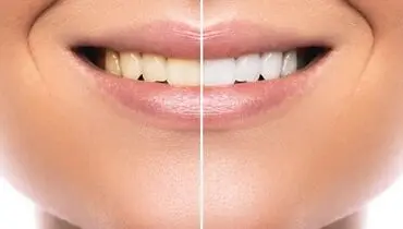 هزینه بلیچینگ دندان در سال 1403