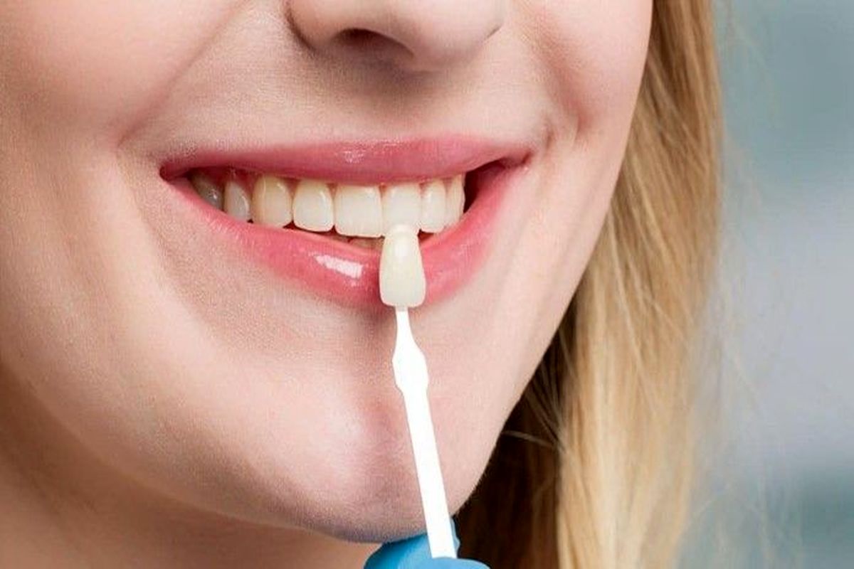 آیا لمینت کردن دندان ها را خراب می کند؟
