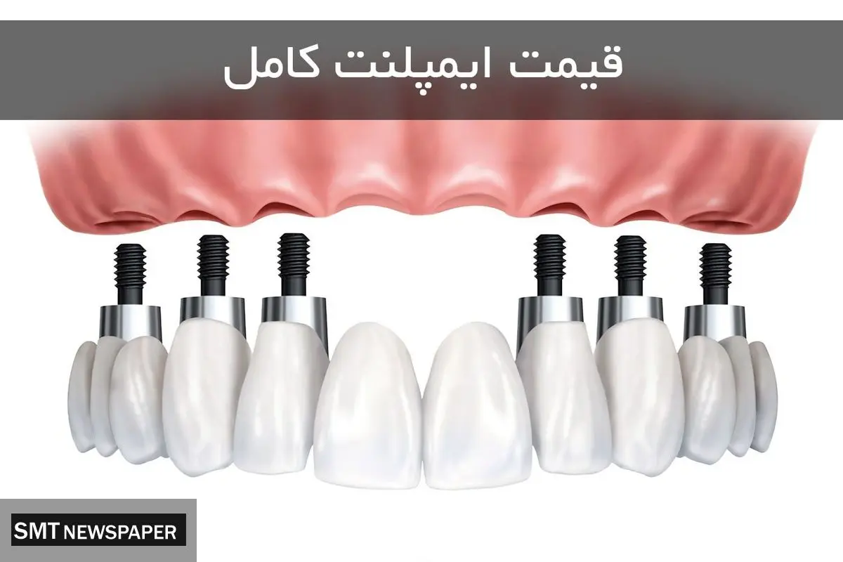قیمت ایمپلنت کامل