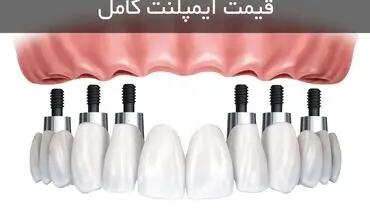 قیمت ایمپلنت کامل