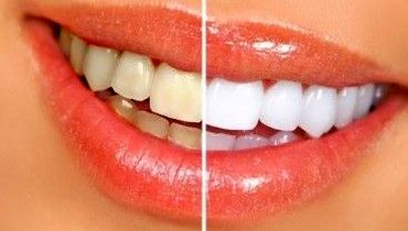 جرم گیری، بلیچینگ یا روش های خانگی سفید کردن دندان، کدام بهتراست؟