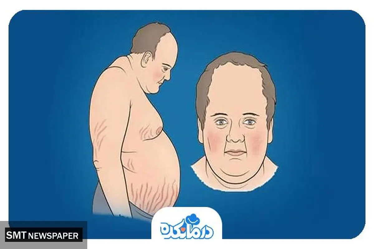 سندرم کوشینگ یاتروژنیک یا Iatrogenic Cushing Syndrome چیست؟