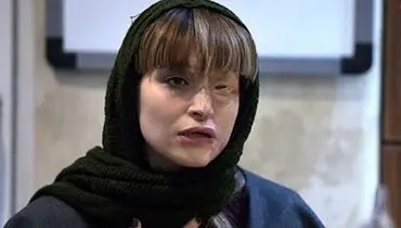 مرضیه یکی از قربانیان اسید پاشی در نمایشگاه جدیدش+جزئیات ازدواج وی
