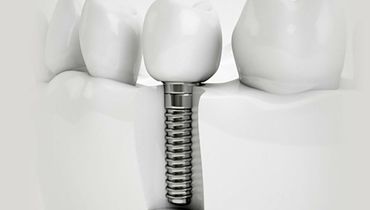 حقایقی در مورد کیفیت ایمپلنت کره ای دنتیس