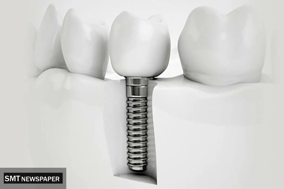حقایقی در مورد کیفیت ایمپلنت کره ای دنتیس