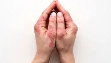 دلایل ابتلا به بیماری پوستی صدفک /هزینه درمان پسوریازیس گزاف است؟