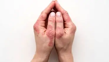 دلایل ابتلا به بیماری پوستی صدفک /هزینه درمان پسوریازیس گزاف است؟