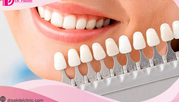 کامپوزیت دندان چیست؟ تفاوت کامپوزیت و لامینیت