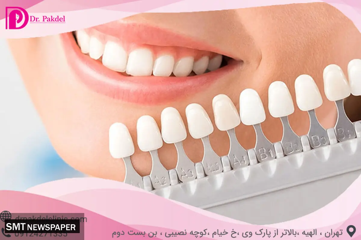 کامپوزیت دندان چیست؟ تفاوت کامپوزیت و لامینیت
