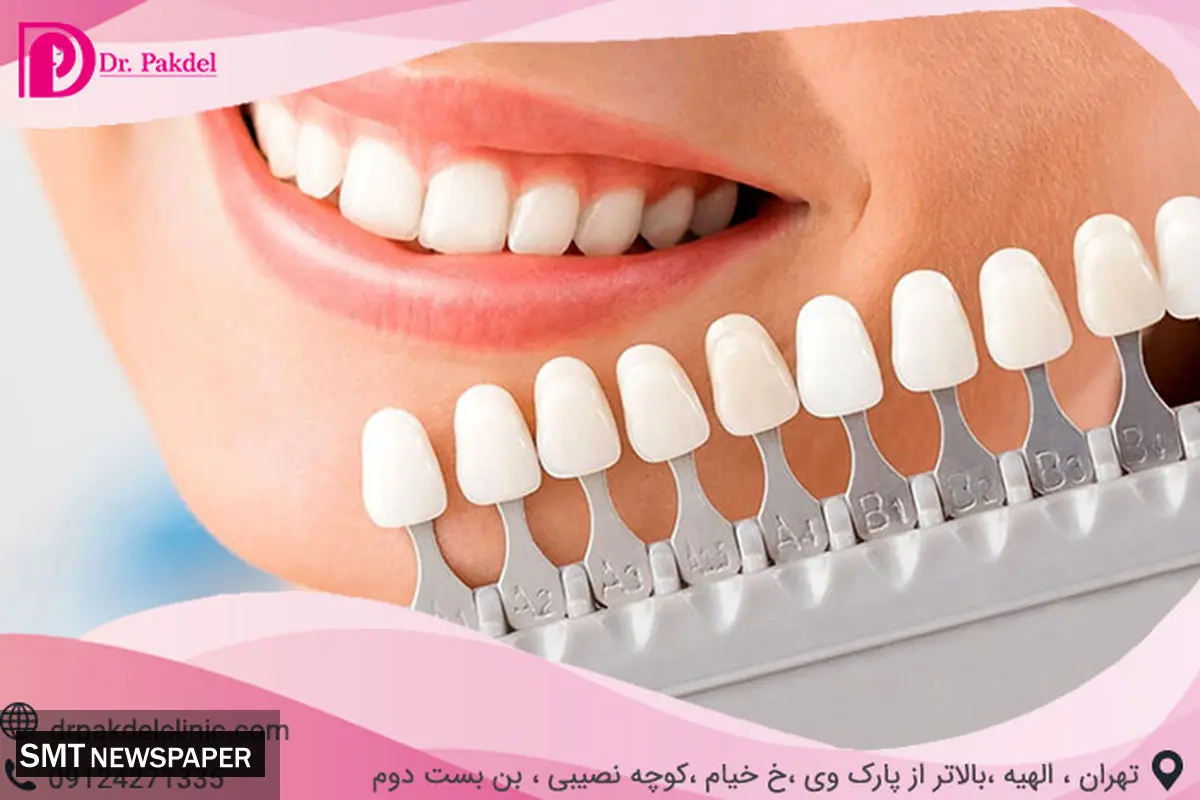 کامپوزیت دندان چیست؟ تفاوت کامپوزیت و لامینیت