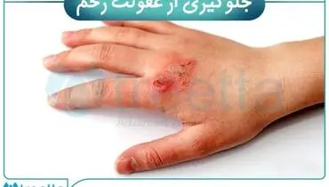 بررسی انواع زخم و درمان انواع زخم | ترمیم زخم با محصولات پیشرفته ایرانی تریتا
