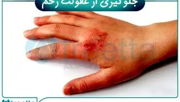 بررسی انواع زخم و درمان انواع زخم | ترمیم زخم با محصولات پیشرفته ایرانی تریتا