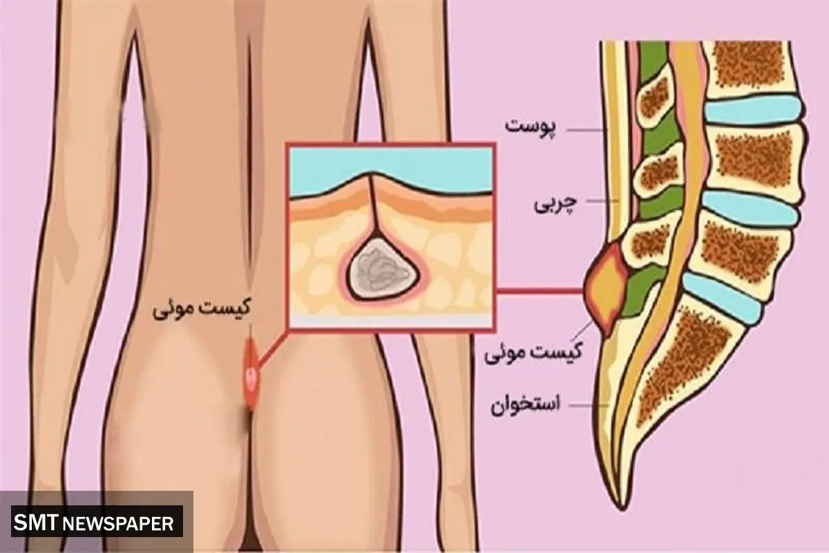 کیست مویی چیست؟ چرا لیزر بهترین راه درمان کیست مویی است؟