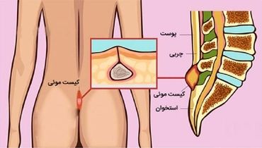 کیست مویی چیست؟ چرا لیزر بهترین راه درمان کیست مویی است؟