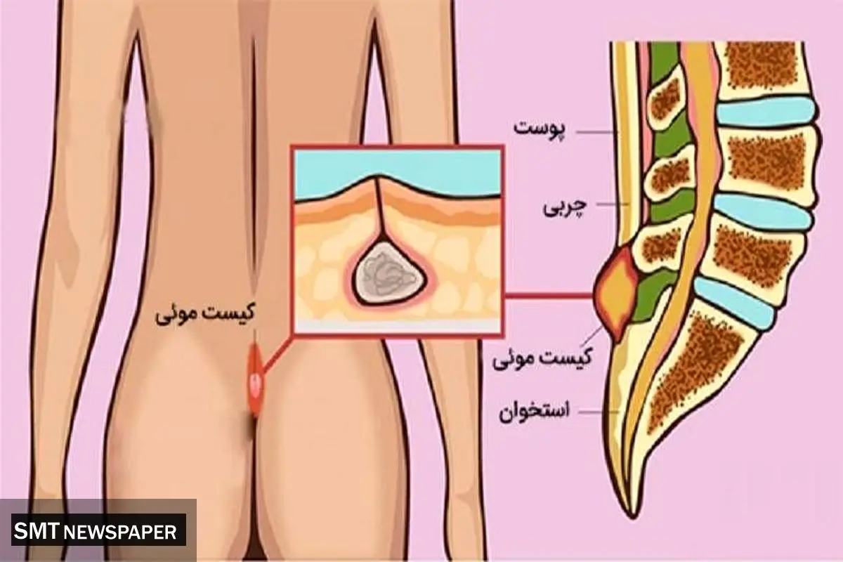کیست مویی چیست؟ چرا لیزر بهترین راه درمان کیست مویی است؟