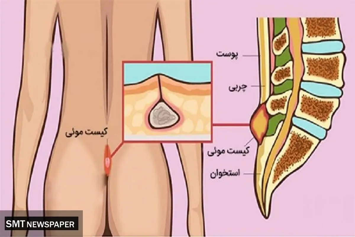 کیست مویی چیست؟ چرا لیزر بهترین راه درمان کیست مویی است؟