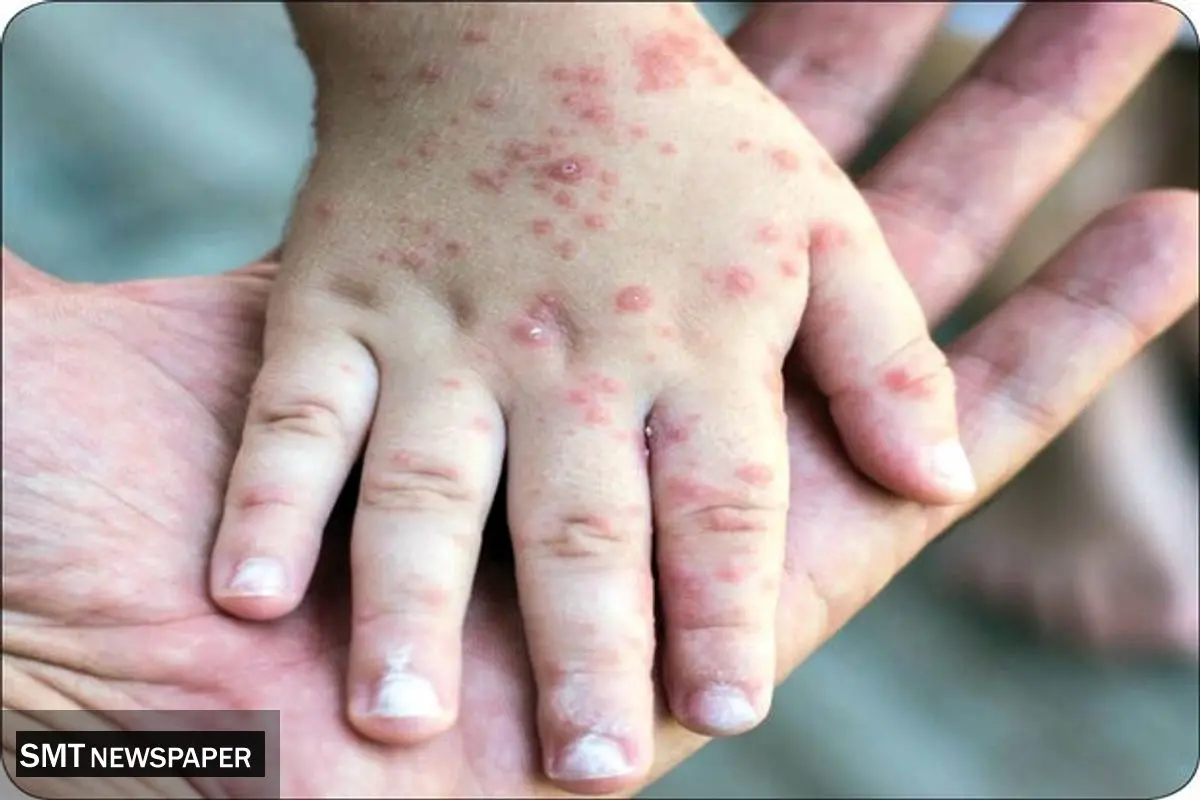 سرخک چیست و چه علائمی دارد ؟