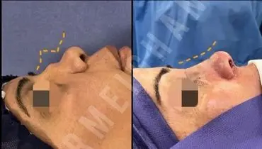 اصلاح فرم بینی با جراحی بدون بیهوشی
