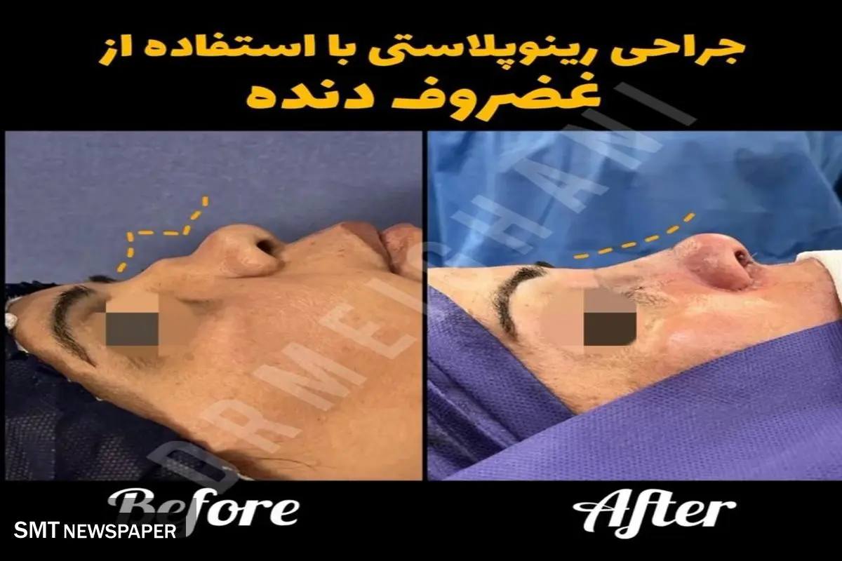 اصلاح فرم بینی با جراحی بدون بیهوشی