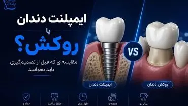 ایمپلنت دندان یا روکش؟ مقایسه‌ای که قبل از تصمیم‌گیری باید بخوانید