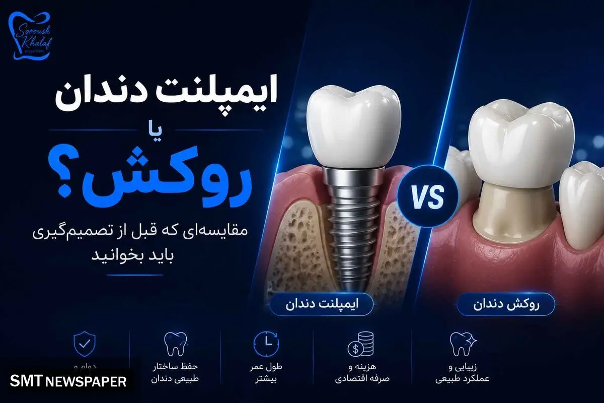 ایمپلنت دندان یا روکش؟ مقایسه‌ای که قبل از تصمیم‌گیری باید بخوانید