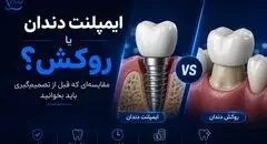 ایمپلنت دندان یا روکش؟ مقایسه‌ای که قبل از تصمیم‌گیری باید بخوانید
