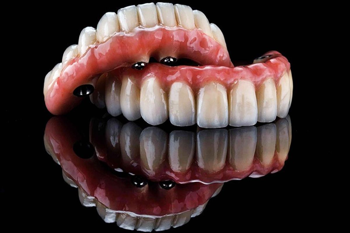 دندان مصنوعی ثابت، بهترین جایگزین برای ایمپلنت دندان!