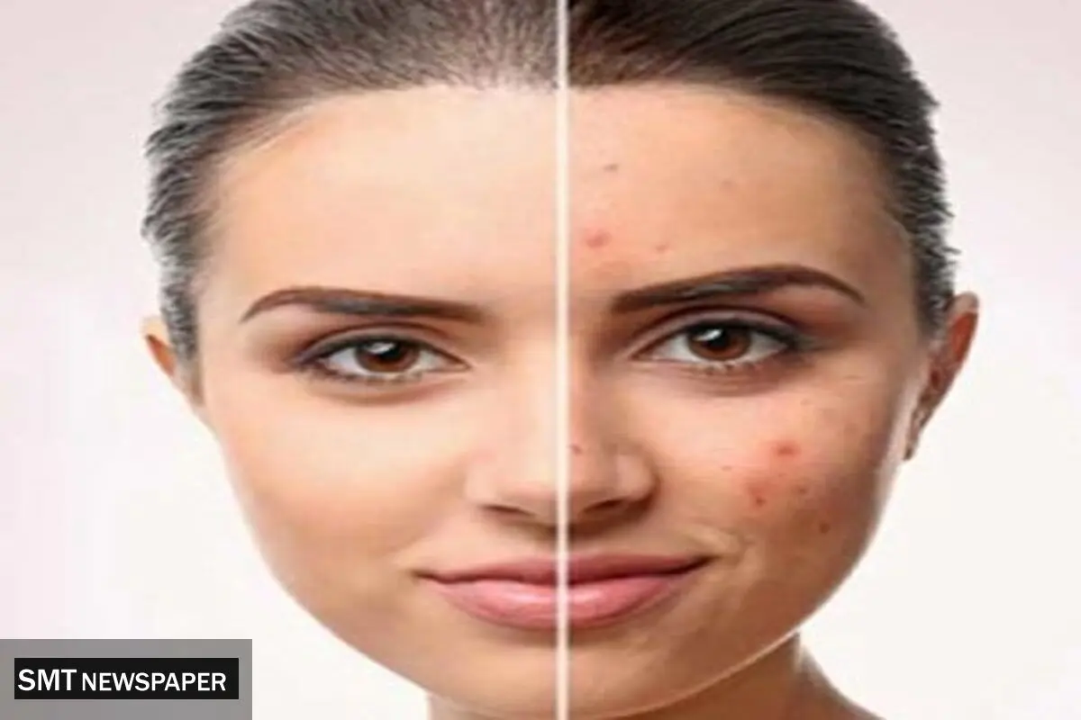 برای جای جوش چی خوبه؟ معرفی بهترین روش های رفع جای جوش