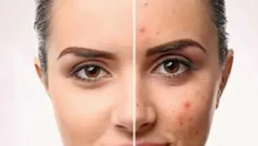 برای جای جوش چی خوبه؟ معرفی بهترین روش های رفع جای جوش