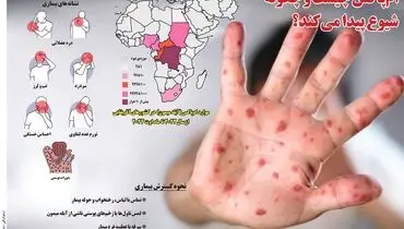 ام پاکس چیست و چگونه شیوع پیدا می کند؟